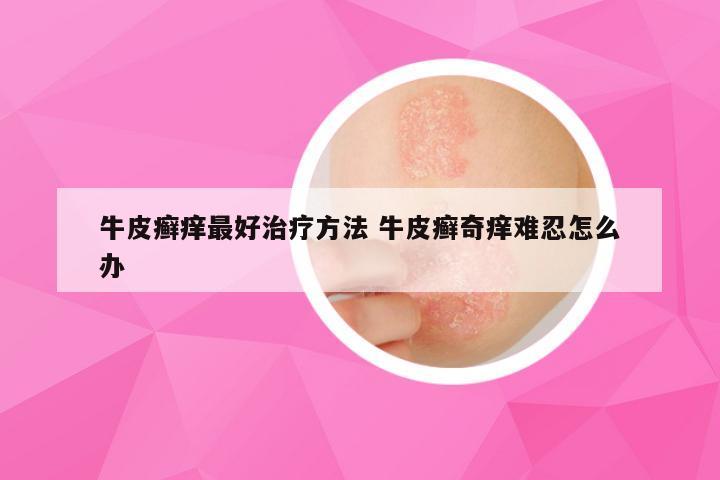 牛皮癣痒最好治疗方法 牛皮癣奇痒难忍怎么办