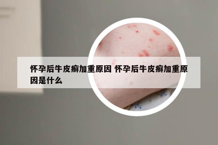 怀孕后牛皮癣加重原因 怀孕后牛皮癣加重原因是什么