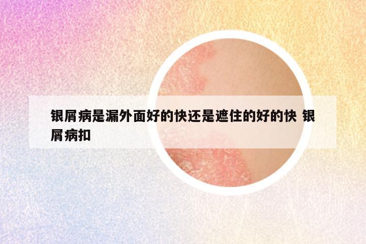 银屑病是漏外面好的快还是遮住的好的快 银屑病扣