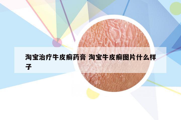 淘宝治疗牛皮癣药膏 淘宝牛皮癣图片什么样子