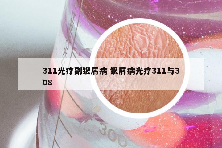 311光疗副银屑病 银屑病光疗311与308
