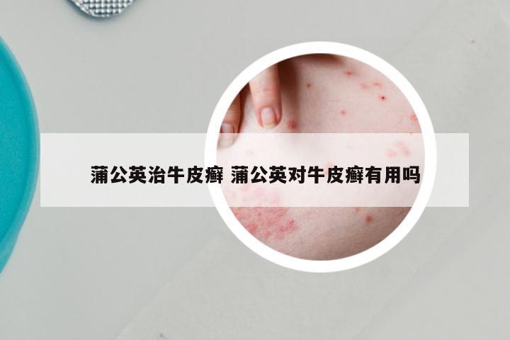 蒲公英治牛皮癣 蒲公英对牛皮癣有用吗