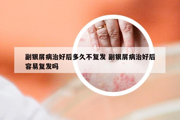 副银屑病治好后多久不复发 副银屑病治好后容易复发吗