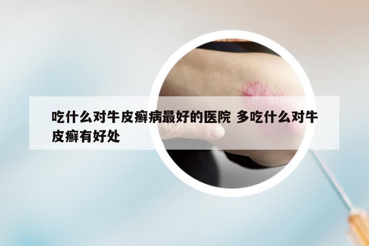 吃什么对牛皮癣病最好的医院 多吃什么对牛皮癣有好处