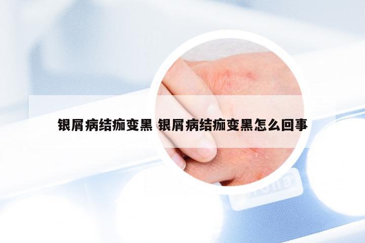 银屑病结痂变黑 银屑病结痂变黑怎么回事