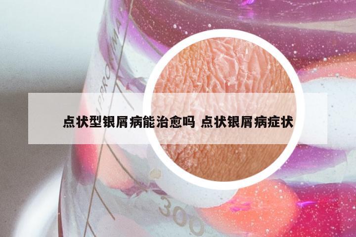 点状型银屑病能治愈吗 点状银屑病症状