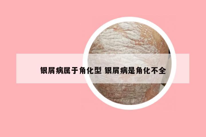 银屑病属于角化型 银屑病是角化不全