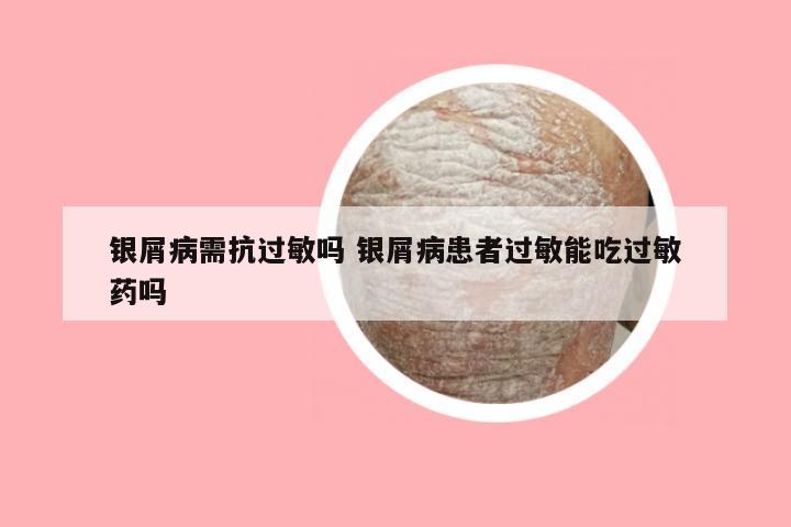 银屑病需抗过敏吗 银屑病患者过敏能吃过敏药吗
