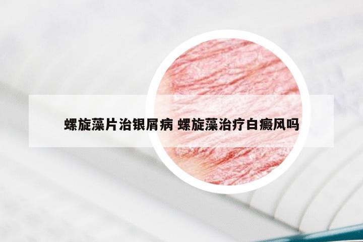 螺旋藻片治银屑病 螺旋藻治疗白癜风吗