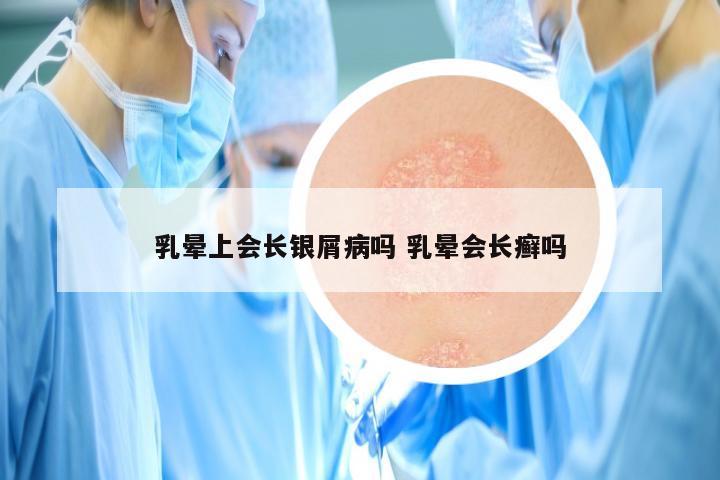 乳晕上会长银屑病吗 乳晕会长癣吗