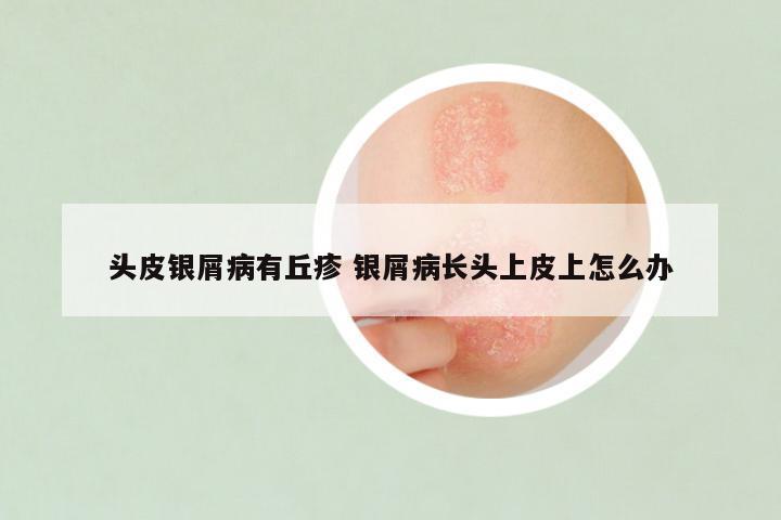 头皮银屑病有丘疹 银屑病长头上皮上怎么办