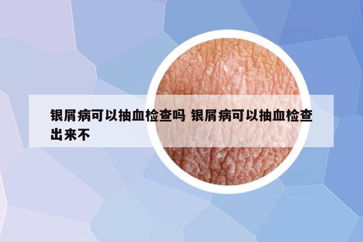 银屑病可以抽血检查吗 银屑病可以抽血检查出来不