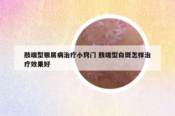 肢端型银屑病治疗小窍门 肢端型白斑怎样治疗效果好