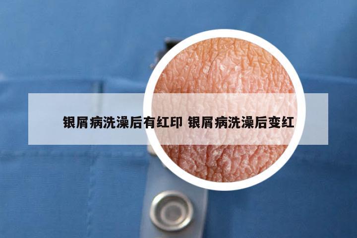 银屑病洗澡后有红印 银屑病洗澡后变红