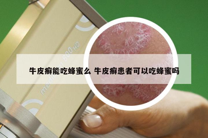 牛皮癣能吃蜂蜜么 牛皮癣患者可以吃蜂蜜吗